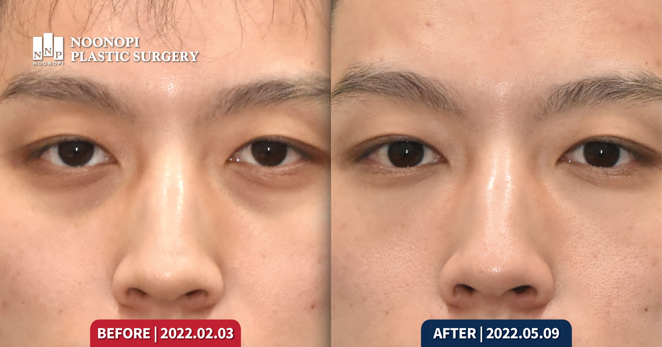 Works 눈밑지방재배치와 눈밑주름 수술의 역사에서 얻은 교훈 005 scaled