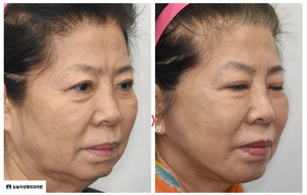 facelift-neck-lift-before-after