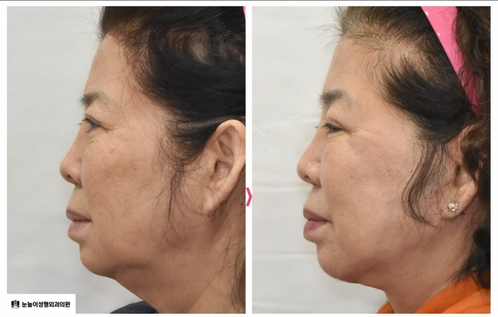 Facelift-and-neck-lift