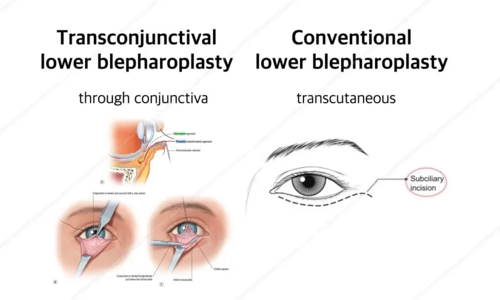 surgical technique for lower blepharoplasty