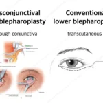 surgical technique for lower blepharoplasty