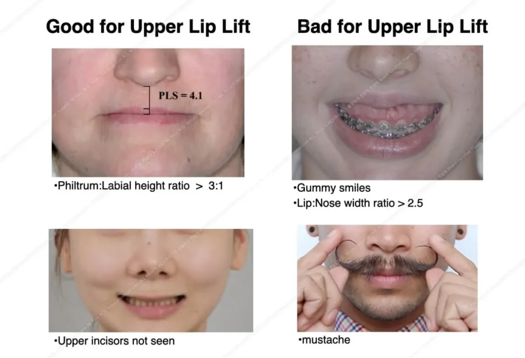 upper lip lift indications