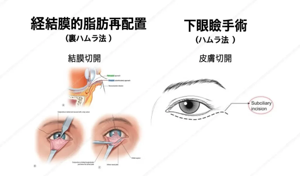 目の下のたるみ取り治療 手術方法