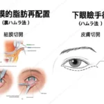 目の下のたるみ取り治療 手術方法