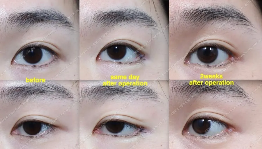 lateral widening of eye