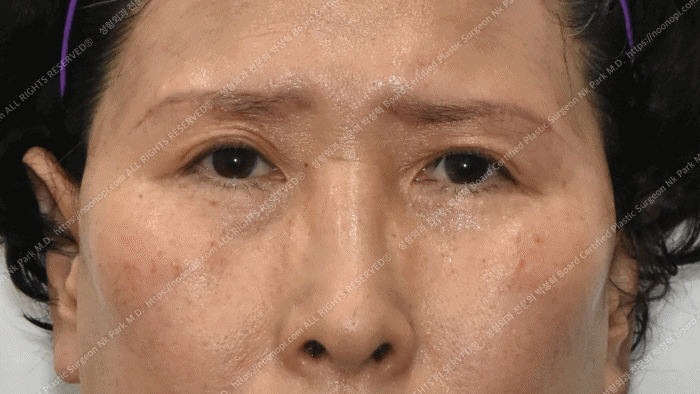 眉毛下切開 前後