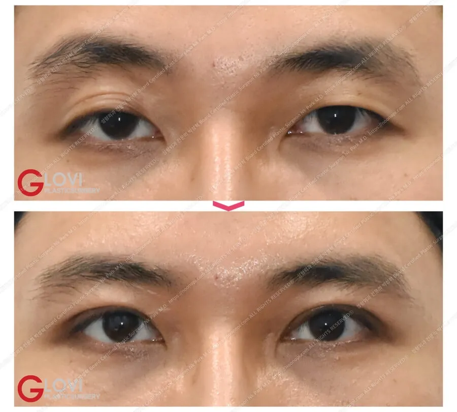 Double eyelid surgery with ptosis correction