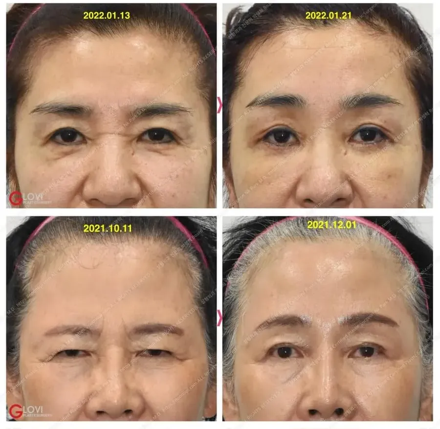 まぶたのたるみ 前後