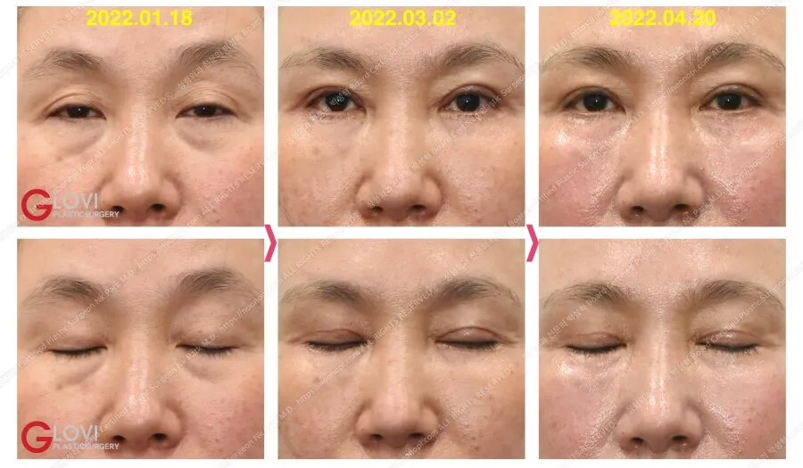 眼瞼下垂手術前後