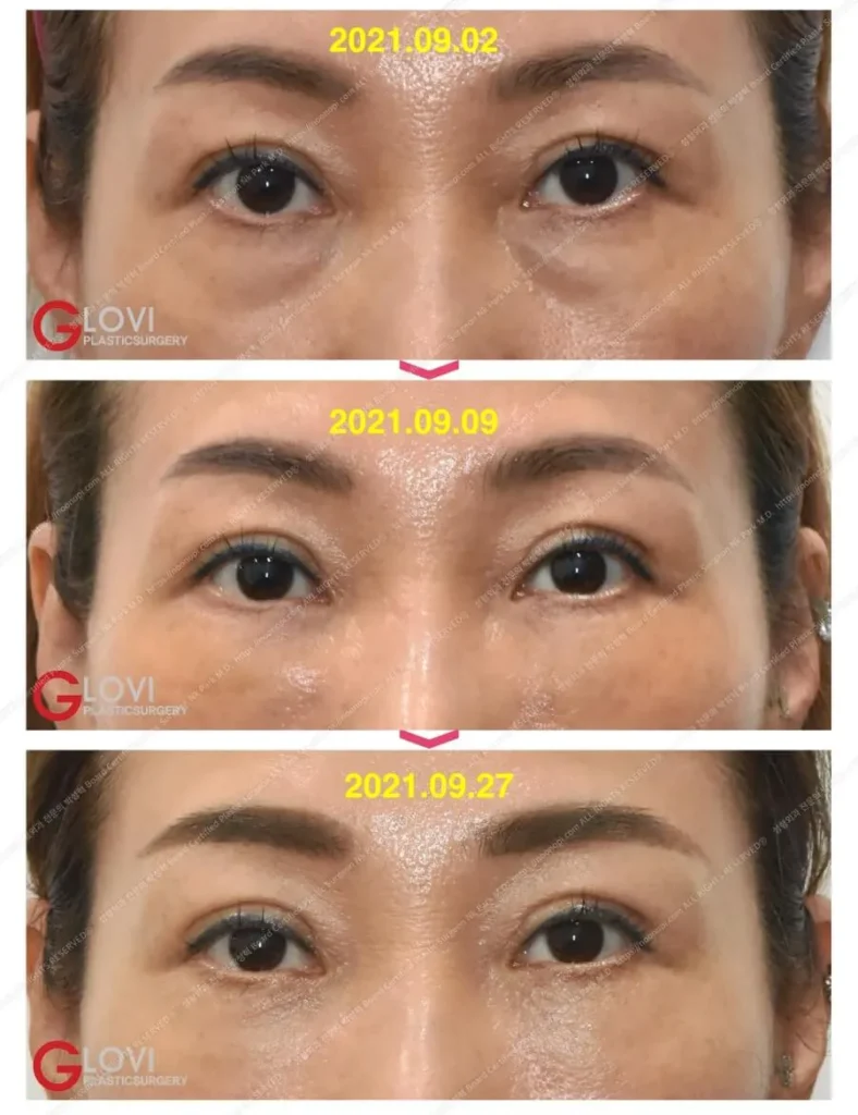 눈밑 지방재배치 전후