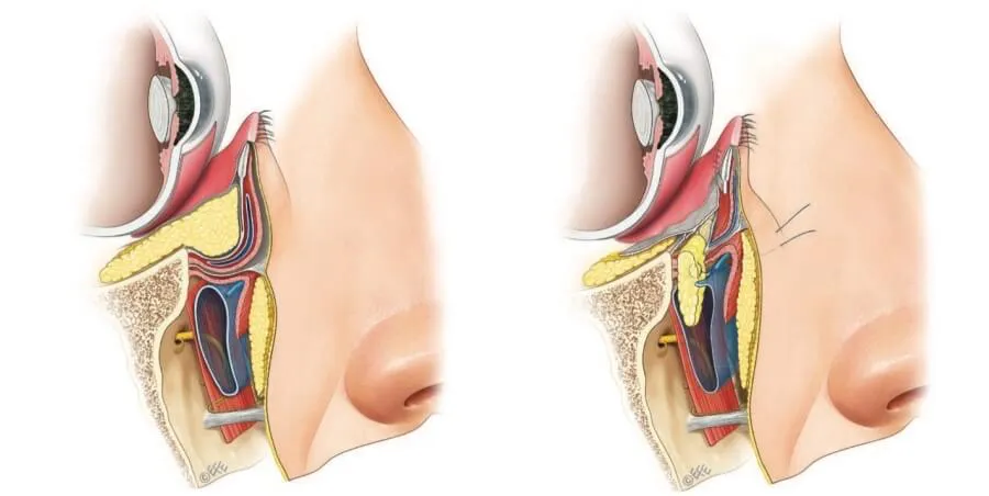 눈밑 지방재배치