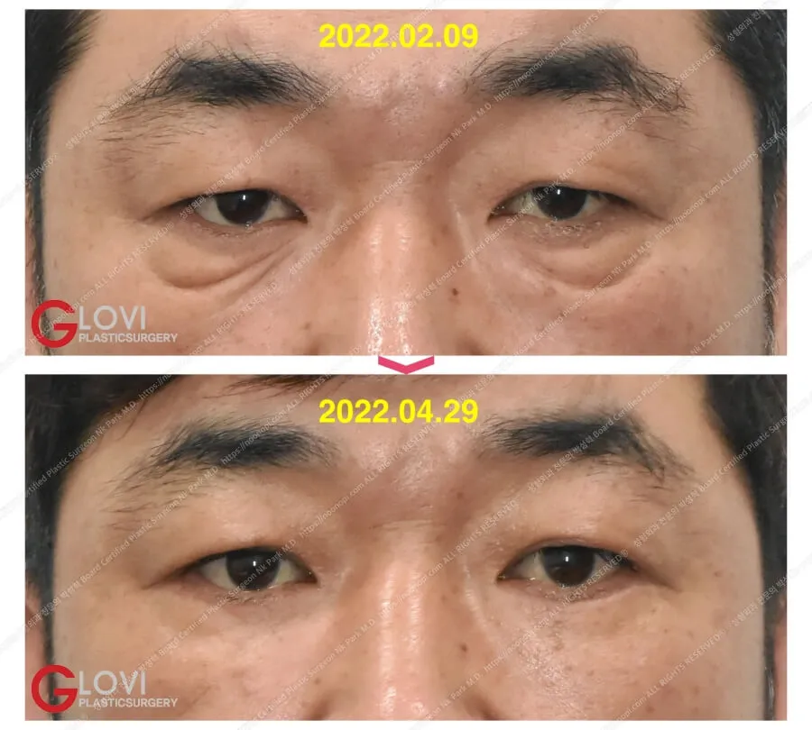 目の下脂肪再配置