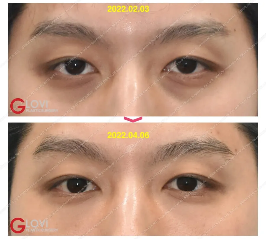 目の下のクマ 口コミア