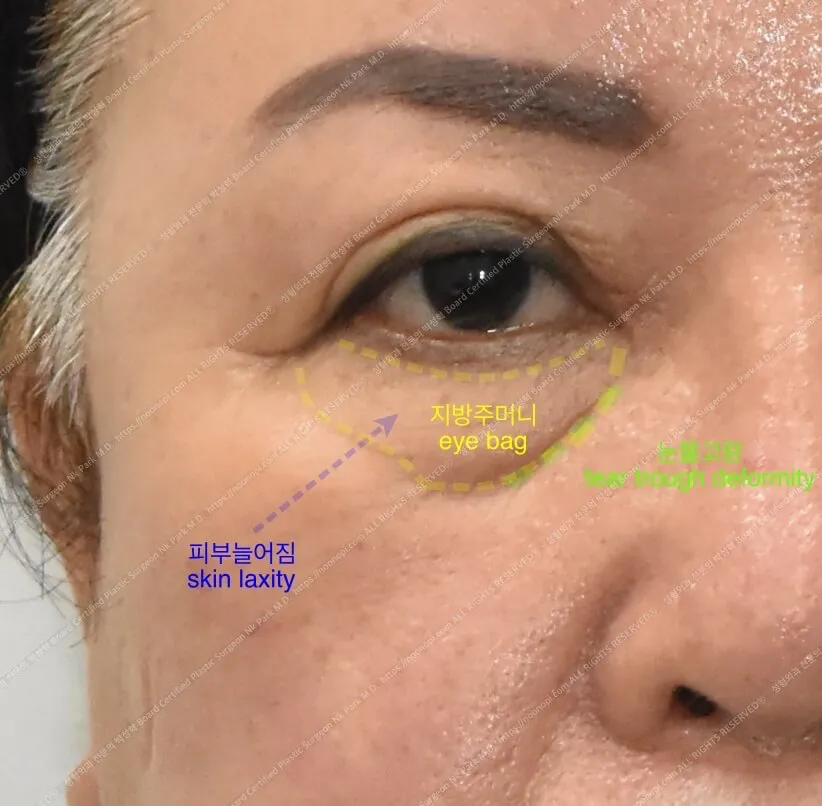 눈밑지방재배치 수술 목표
