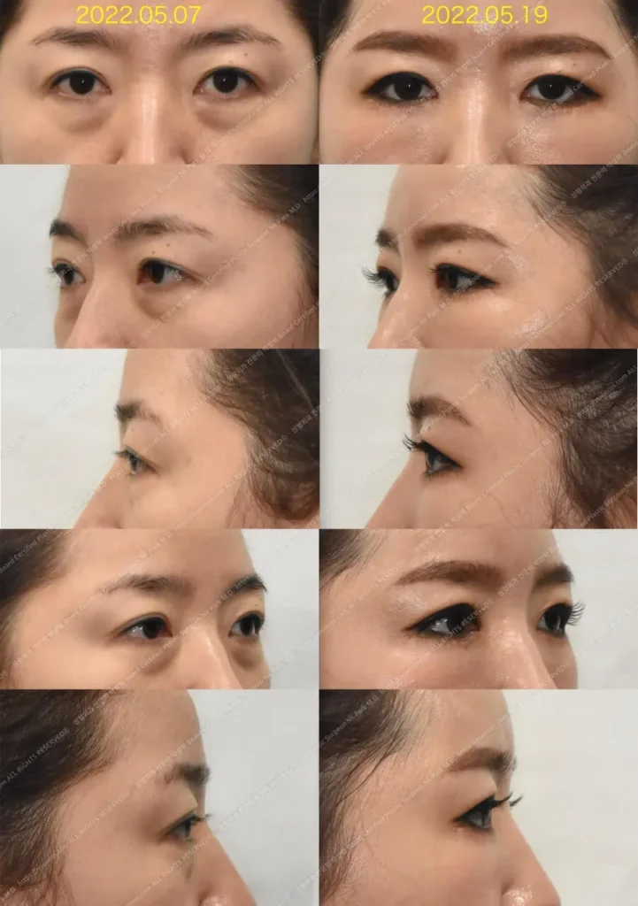 눈밑지방재배치 지방이식