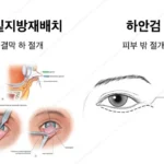 눈밑지방재배치 하안검 차이