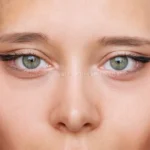 이거... 성형 실패인가요? (feat. 눈성형 부작용)