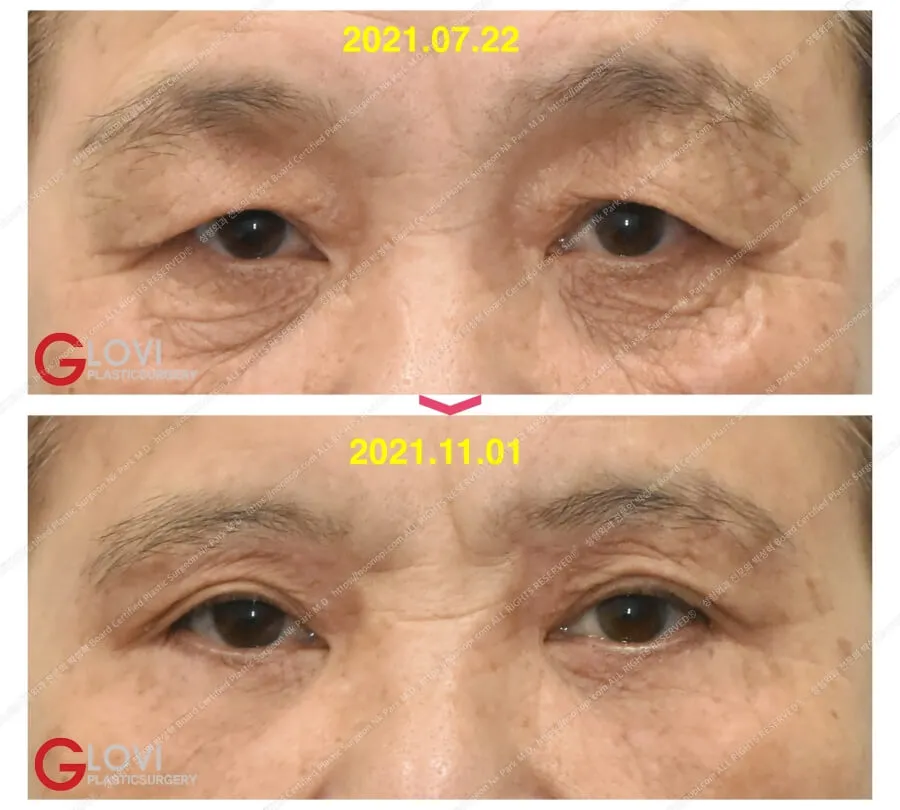 眉毛下切開 口コミア