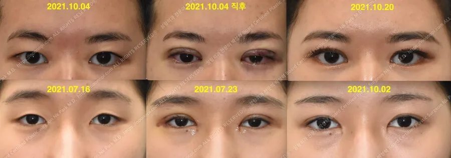 매몰 쌍수 후기