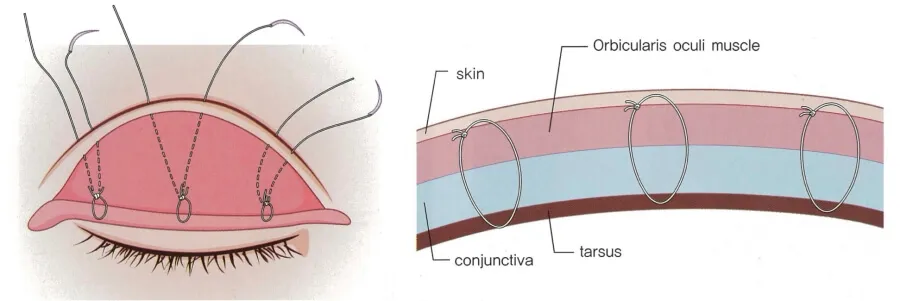 매몰 쌍수