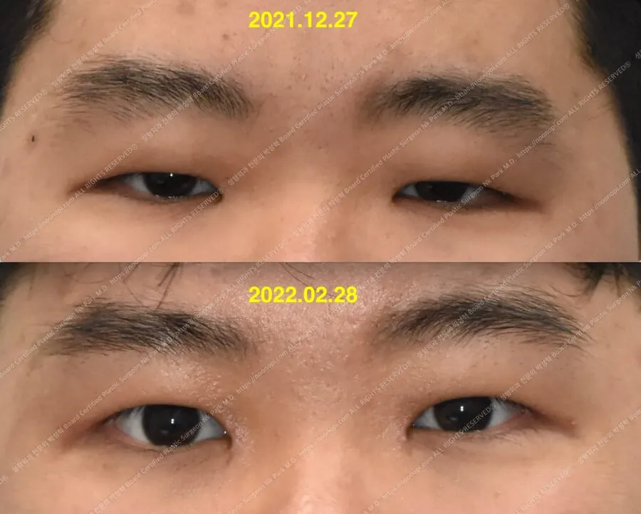 Monolid surgery with ptosis correction