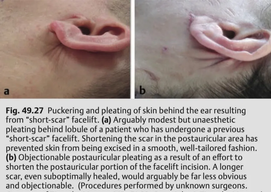 미니거상 부작용