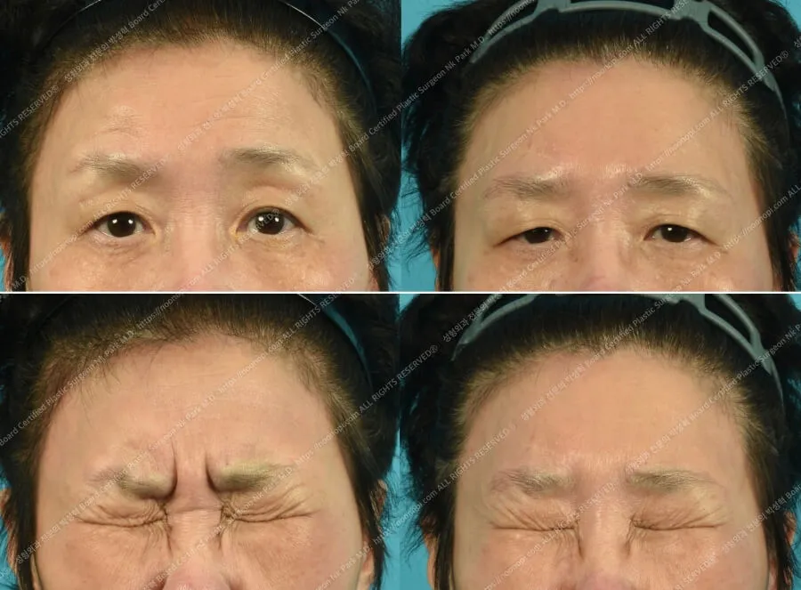 보톡스 눈썹 처짐