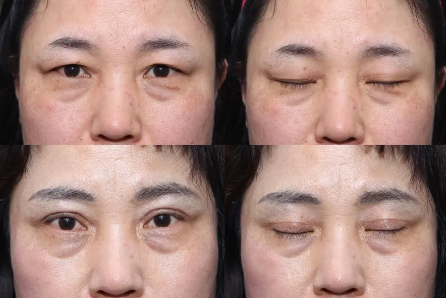 상안검 눈썹처짐