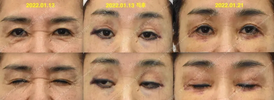 성형 후 눈 안감김