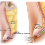 쌍꺼풀과 상안검 수술을 위한 총정리 가이드