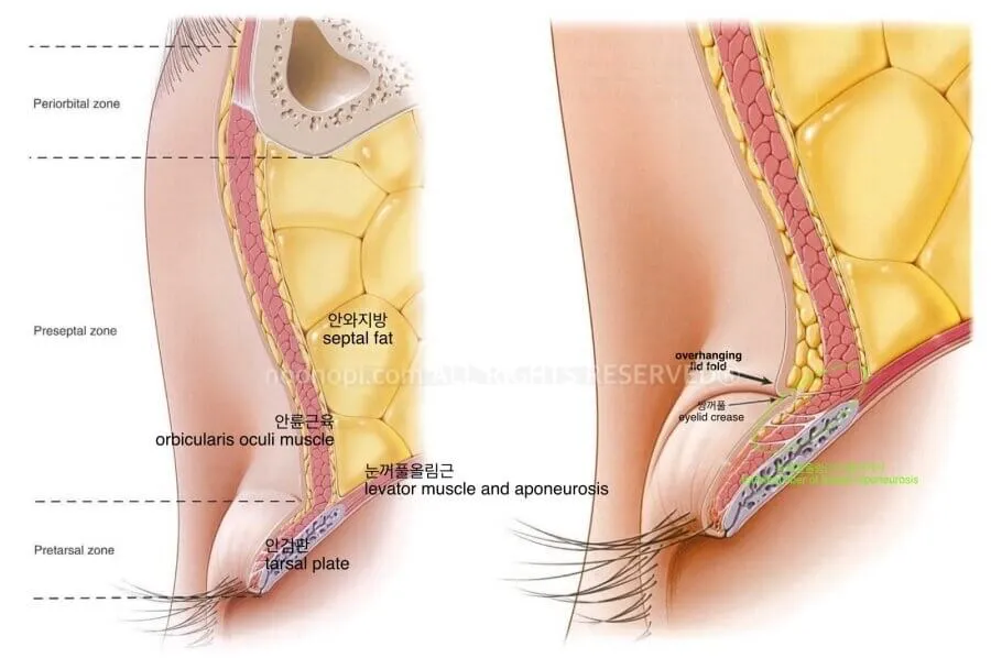쌍수-붓기-기간
