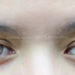 쌍꺼풀 수술의 논쟁 : 눈매교정 총정리 가이드