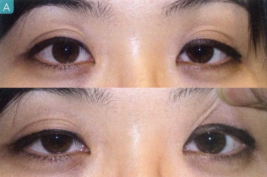 안검하수 헤링의 법칙