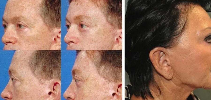 안면거상 절개 부작용