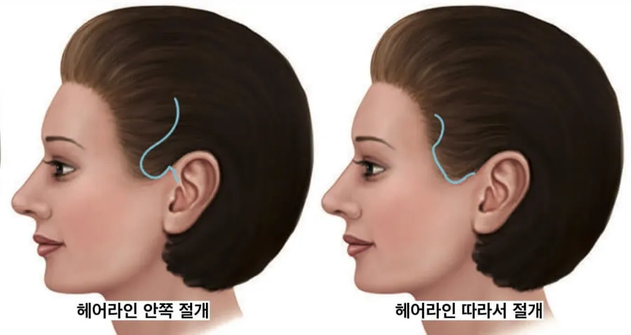 안면거상 절개위치 관자