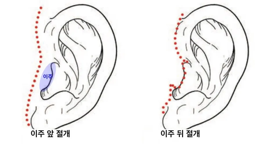 안면거상 절개위치 귀