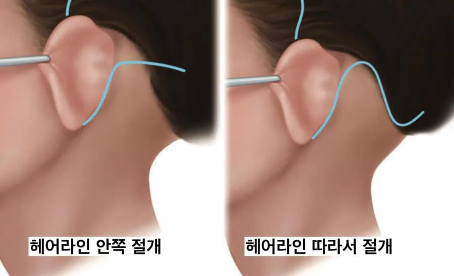 안면거상 절개위치 귀뒤
