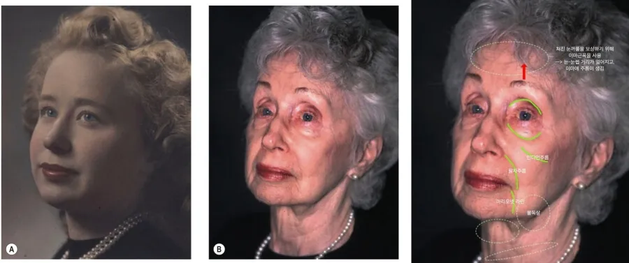 얼굴 노화