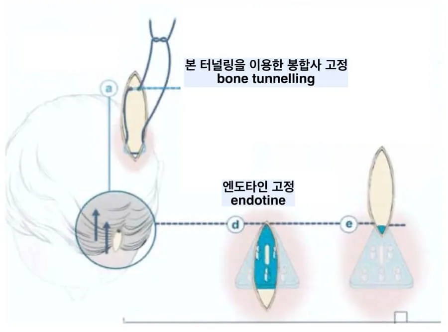 엔도타인 vs 본터널링 사진