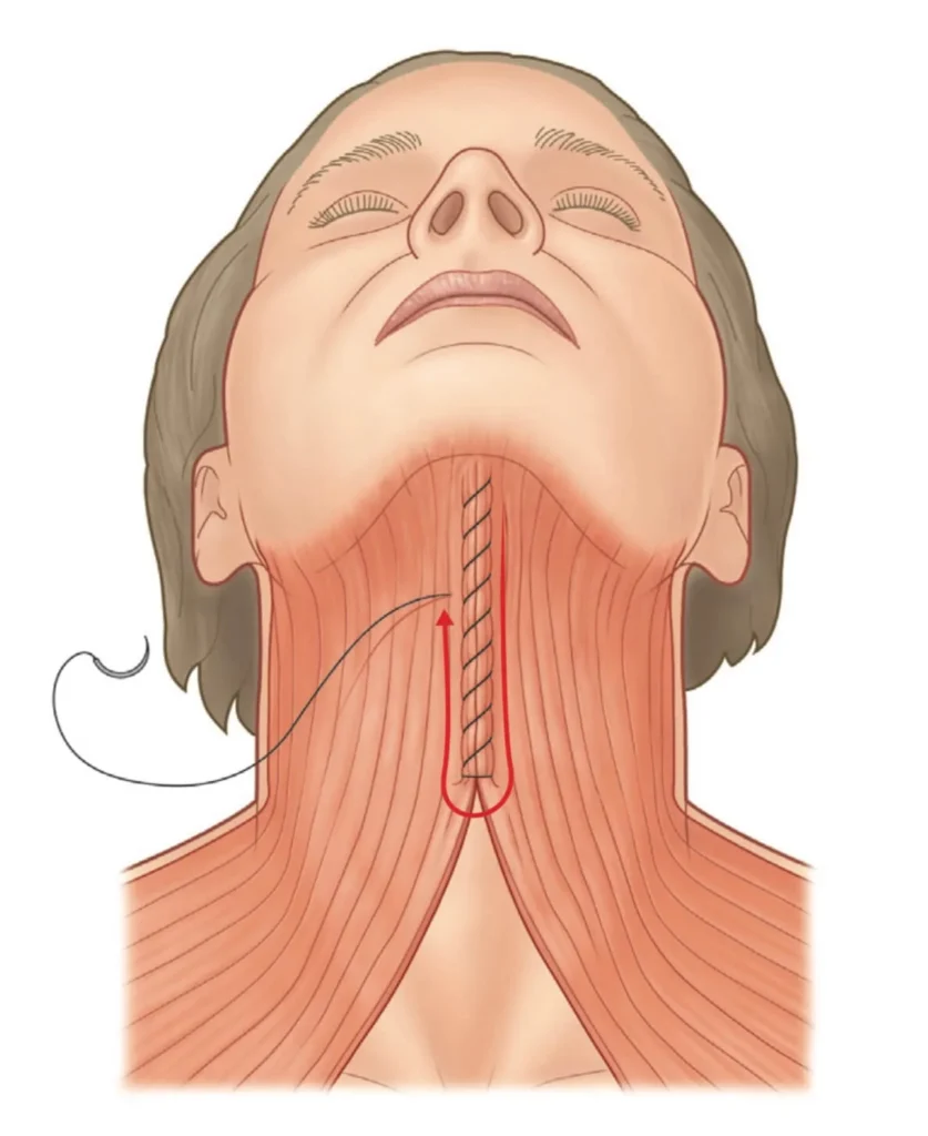 이중턱 근육묶기