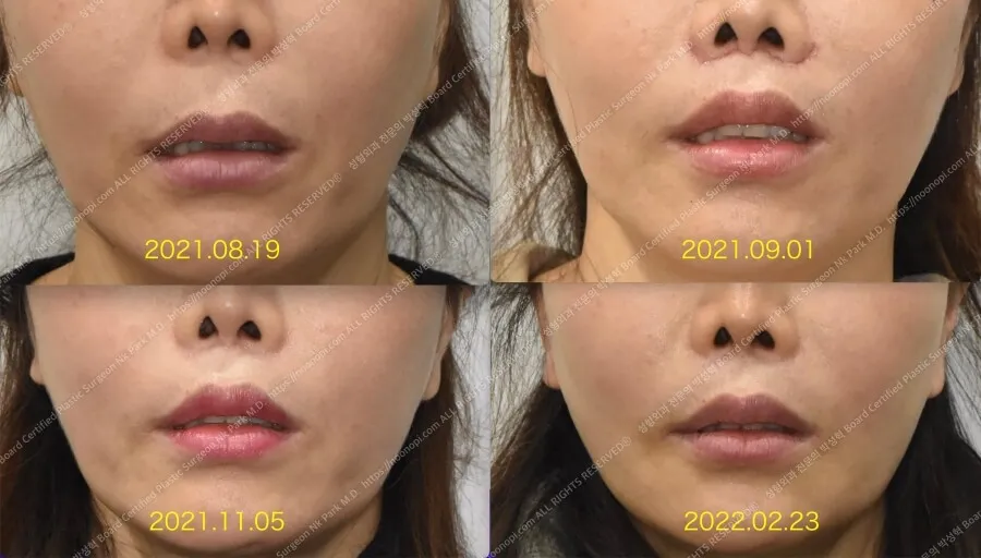 リップリフト 前後