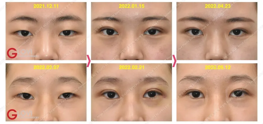 double eyelid surgery before after
