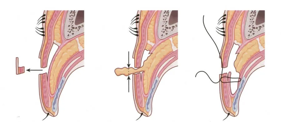 절개 쌍수