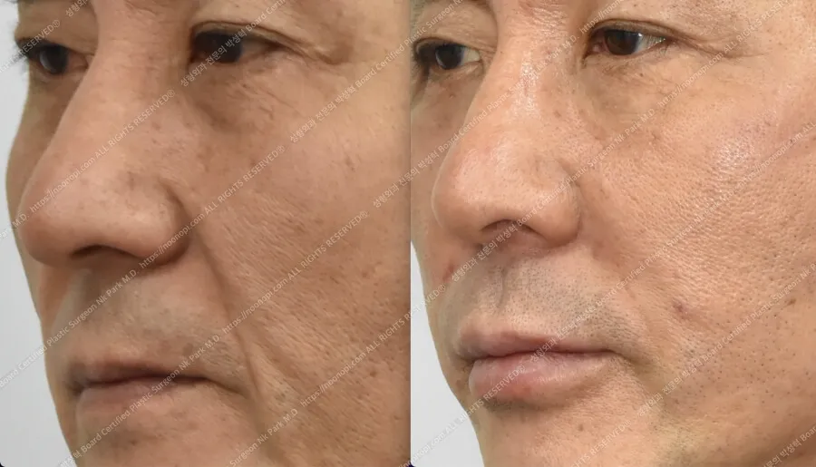 리프팅 팔자주름 없애기