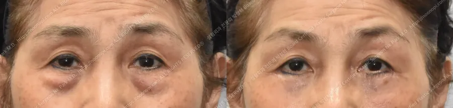 눈밑주름 2개월