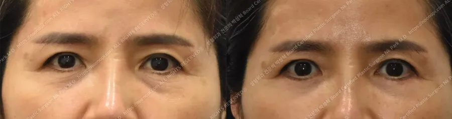 눈밑주름 수술 후 3개월