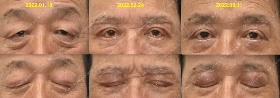 하안검 결막부종 삼백안