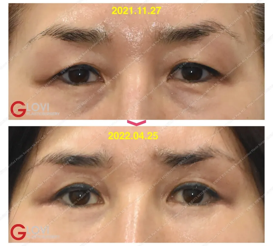 하안검 성형 눈썹하거상