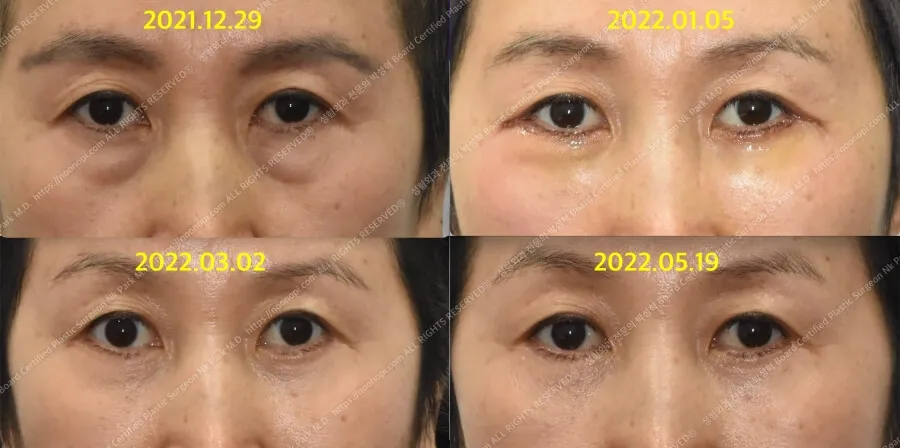 눈가주름 수술후 2개월 4개월 