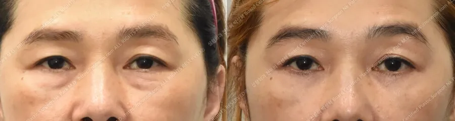 하안검 수술 3개월